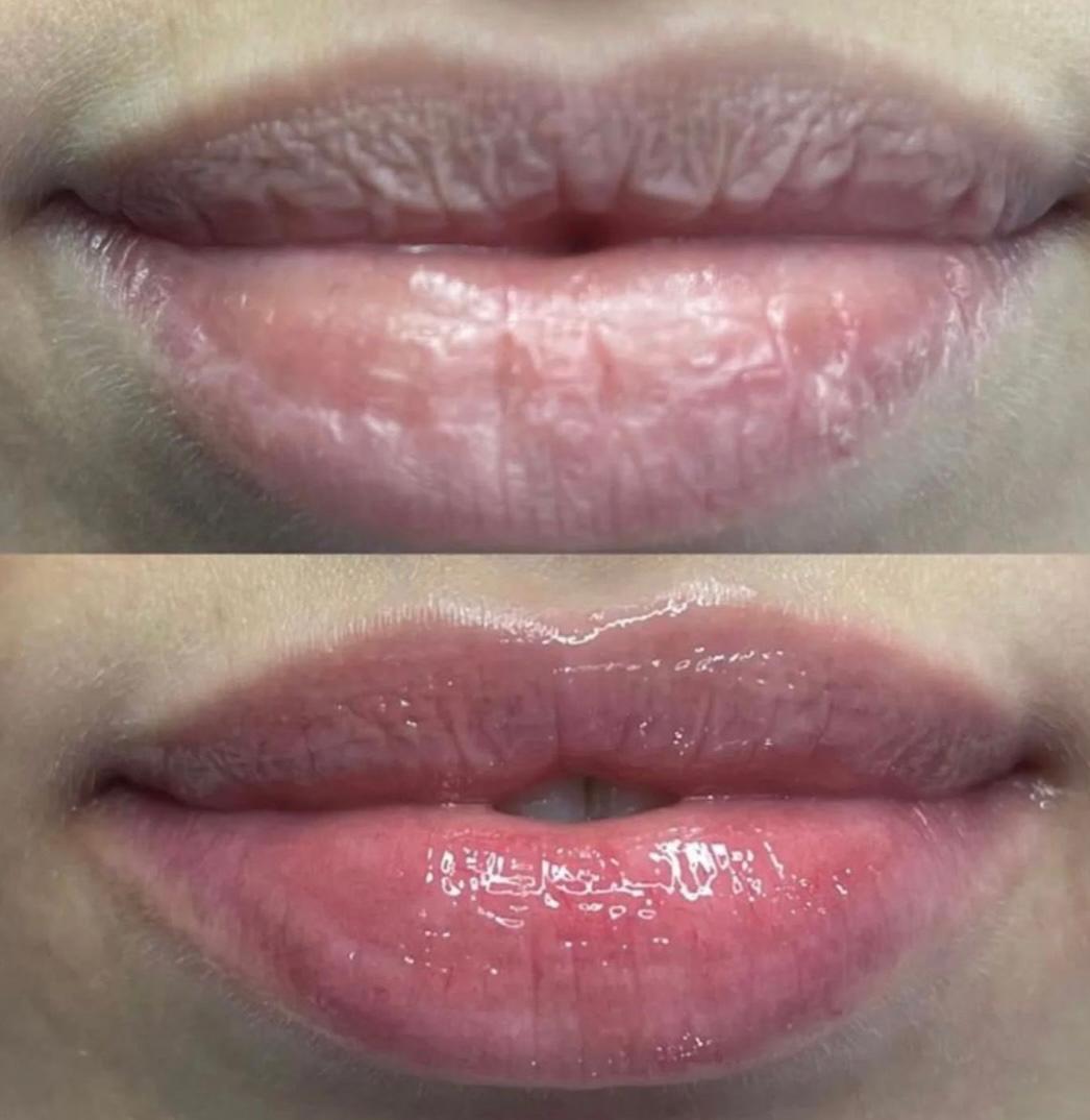 Restauração e Rejuvenescimento Labial